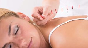 Woman laying face down looking relaxed as she receives acupuncture treatment in Melbourne with acupuncture needles applied to her back for pain relief and management